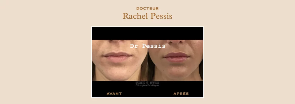 Repulper volume lèvres chirurgie esthétique à Paris