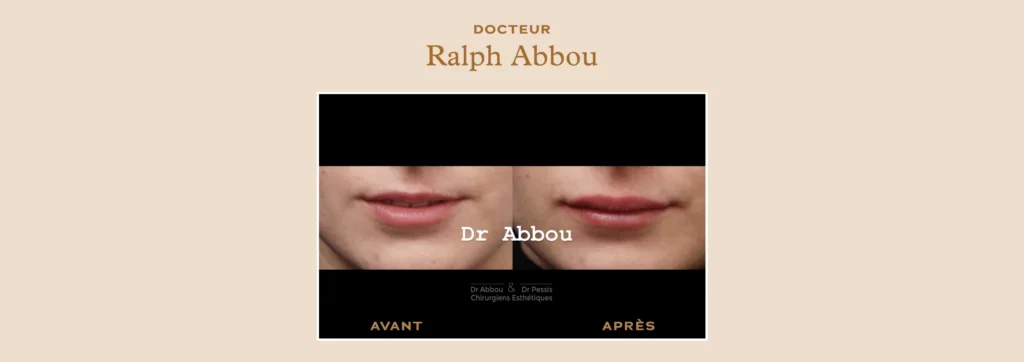 Repulper volume lèvres chirurgie esthétique à Paris