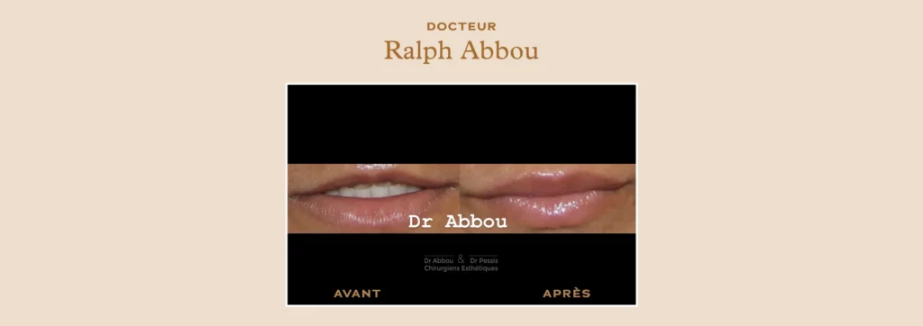 Repulper volume lèvres chirurgie esthétique à Paris