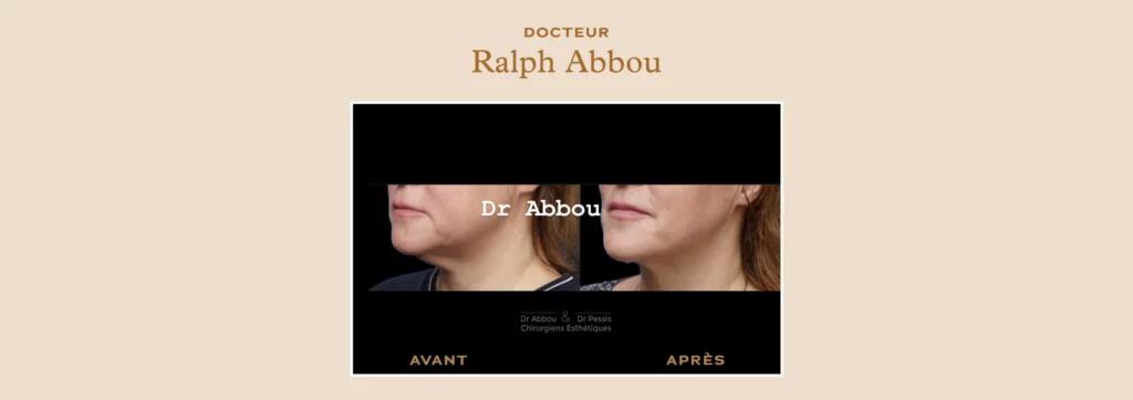 Lifting du visage chirurgie esthétique à Paris