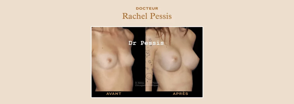 Augmentation mammaire chirurgie esthétique à Paris