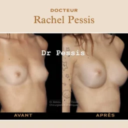 Augmentation mammaire chirurgie esthétique à Paris