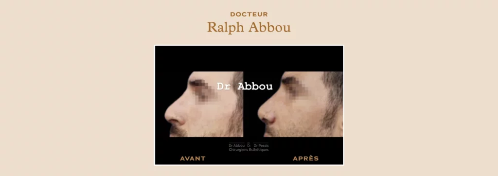 rhinoplastie secondaire à Paris