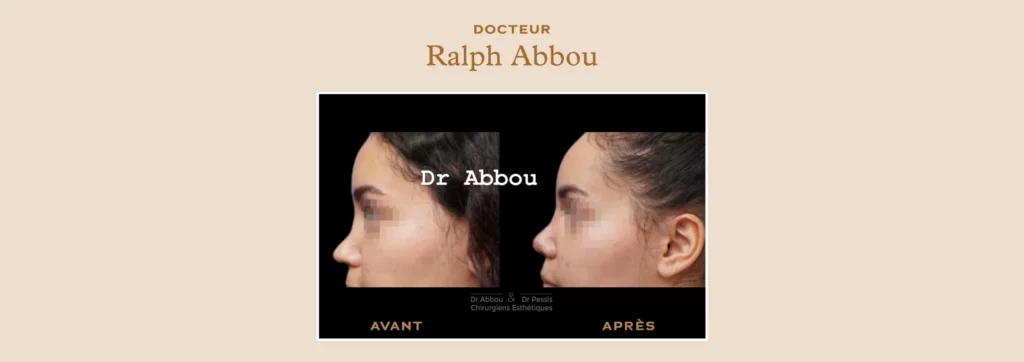 rhinoplastie secondaire à Paris