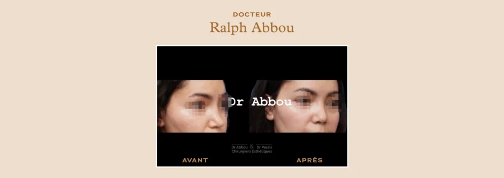 rhinoplastie secondaire