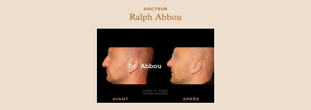 rhinoplastie ultrasonique à Paris