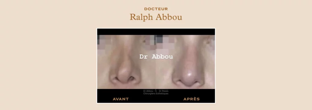 rhinoplastie ultrasonique à Paris