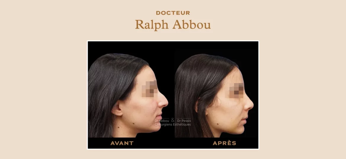 rhinoplastie ultrasonique Paris