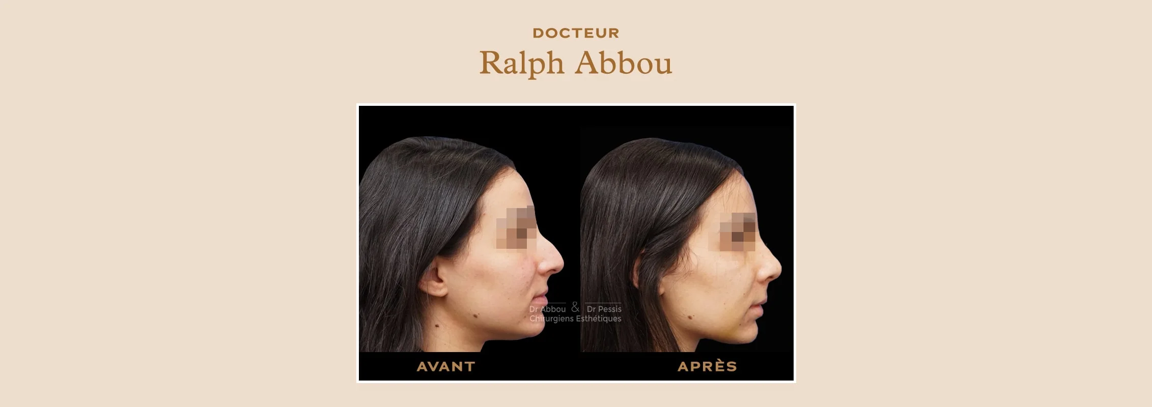 rhinoplastie ultrasonique Paris