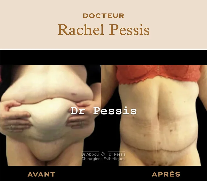 Abdominoplastie: quel poids avant une chirurgie réparatrice du ventre?