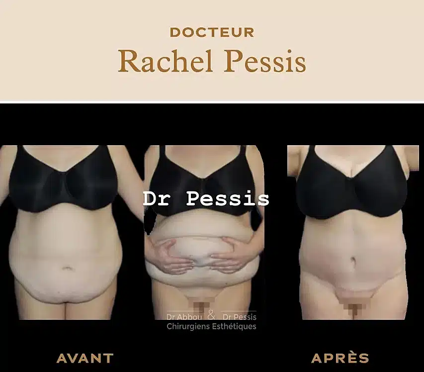 Gaine Après Abdominoplastie