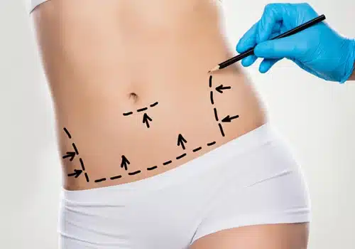 abdominoplasty