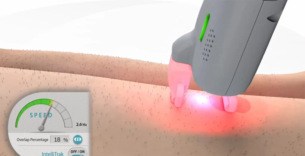 Epilation laser à paris