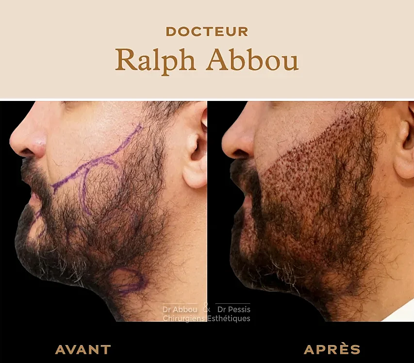 Greffe de barbe Paris - Dr Ralph Abbou - Chirurgien esthétique