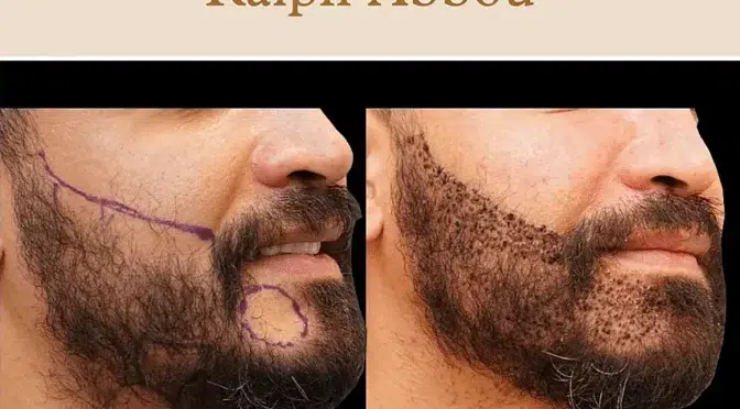 Greffe de barbe Paris - Dr Ralph Abbou - Chirurgien esthétique