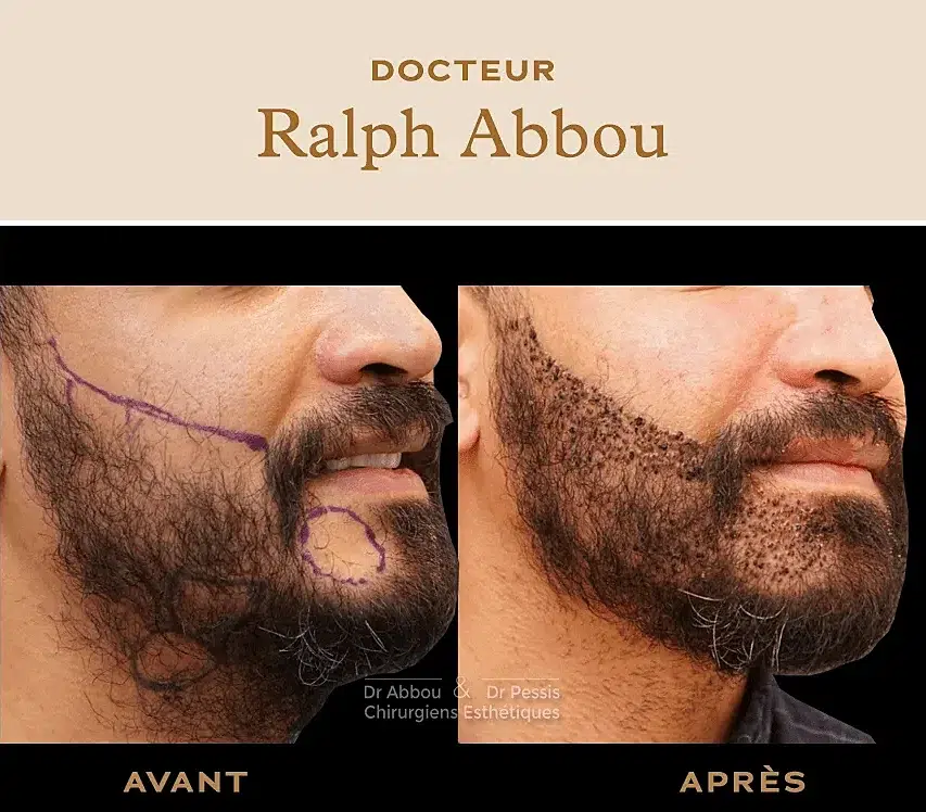 Greffe de barbe Paris - Dr Ralph Abbou - Chirurgien esthétique