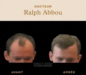 implant capillaire paris ou greffe de cheveux