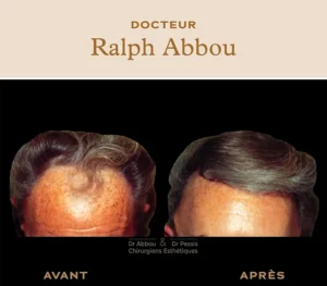 Greffe de cheveux à paris