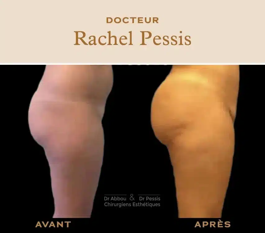 Augmentation des fesses Paris -Dr Abbou