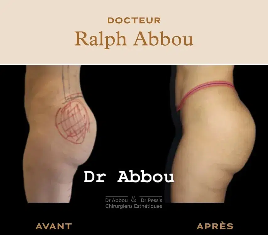 Augmentation des fesses Paris -Dr Abbou