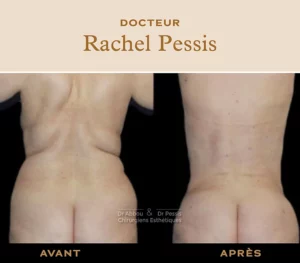 Liposuccion du dos chirurgie esthétique paris