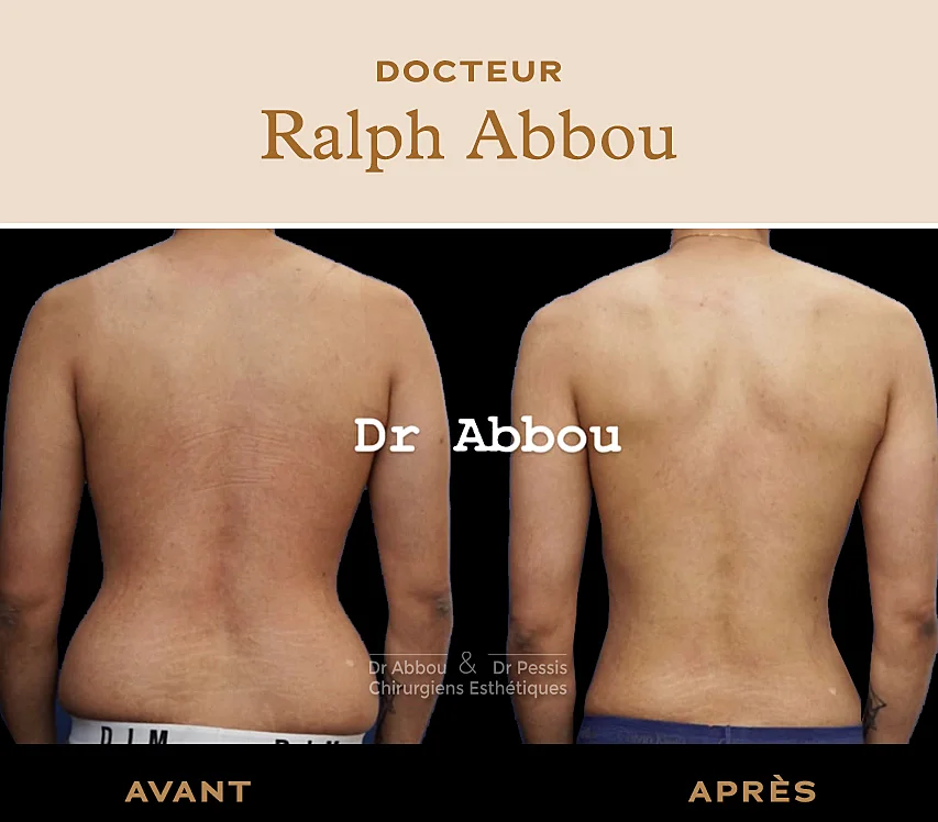 Liposuccion du dos à Paris. Dr ABBOU et PESSIS