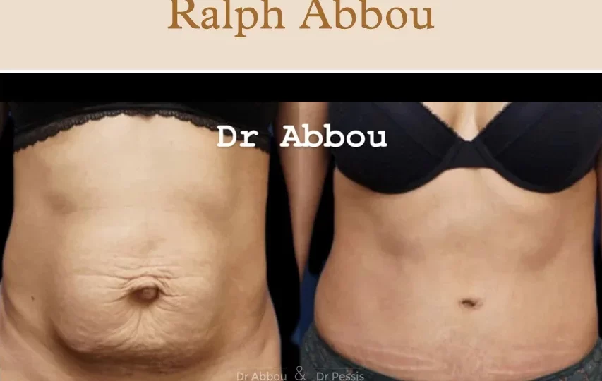 mini abdominoplastie