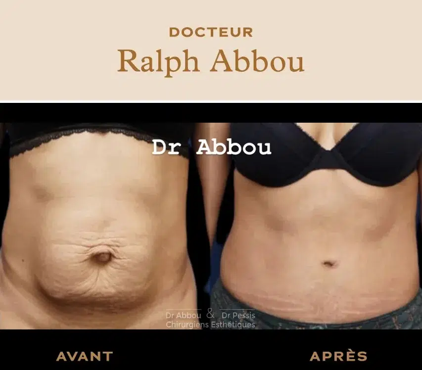 mini abdominoplastie