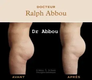 Prothèse de fesses