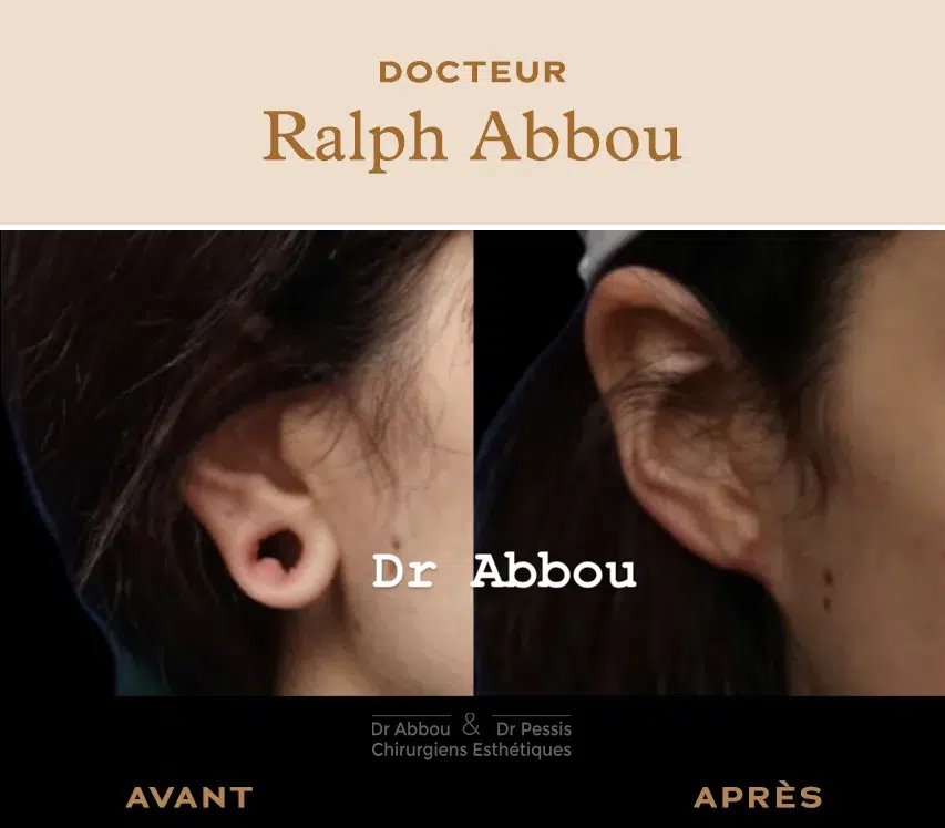 Reconstruction de l'oreille chirurgie esthétique à Paris