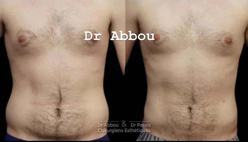 Reduction de graisse sans chirurgie à Paris Reduction de graisse sans chirurgie à Paris
