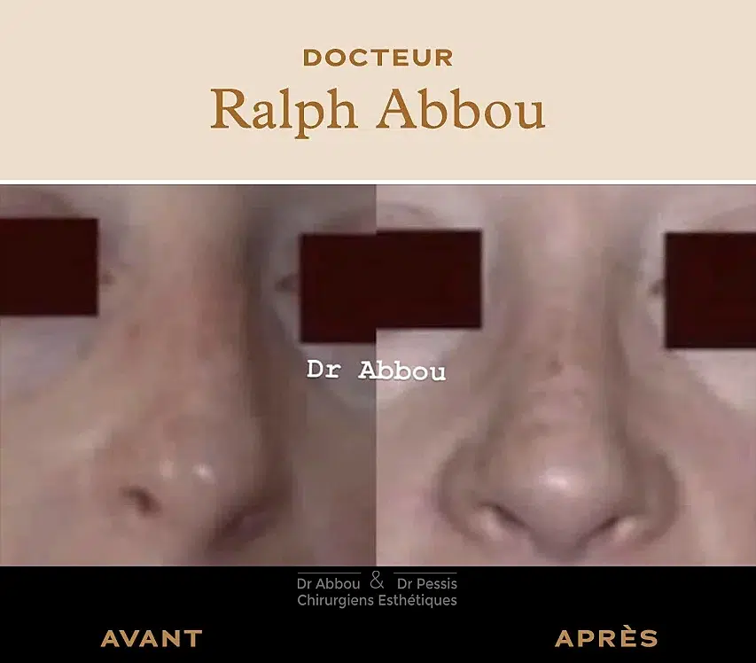 Nez cassé. Rhinoplastie post traumatique à Paris. Dr ABBOU