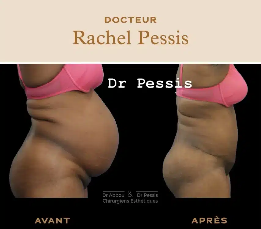 Traitement du diastasis à Paris. Dr ABBOU et Dr PESSIS