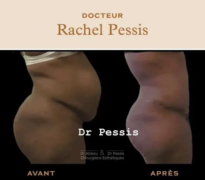 Traitement du diastasis à Paris. Dr ABBOU et Dr PESSIS