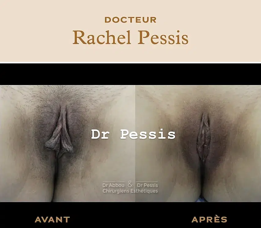 vaginoplastie chirurgie esthétique à Paris