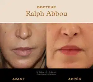Lipofilling des lèvres chirurgie esthétique à Paris