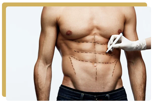 Abdominal etching Paris