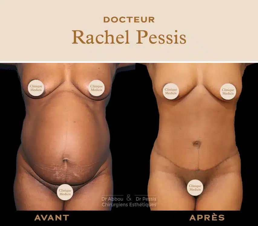 La gaine d'abdominoplastie : Pourquoi porter une gaine post