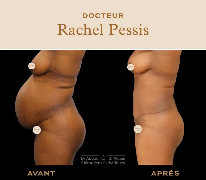 Traitement du diastasis à Paris. Dr ABBOU et Dr PESSIS