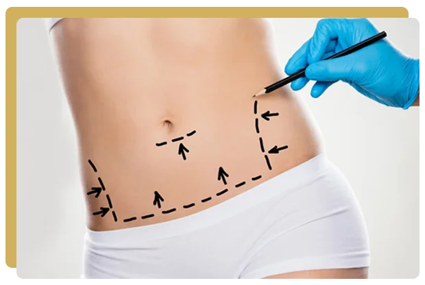 Abdominoplastie paris