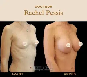 implantation mammaire : photo avant apres augmentation mammaire