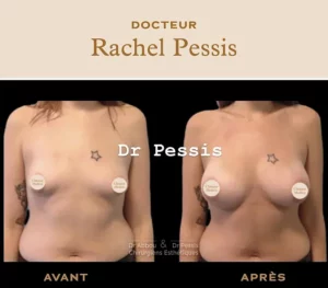 Augmentation mammaire Paris