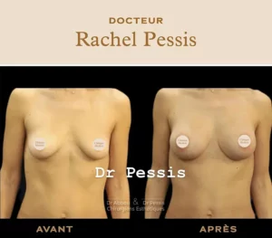 Augmentation mammaire Paris