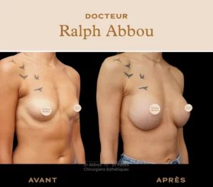 Augmentation mammaire par protheses paris
