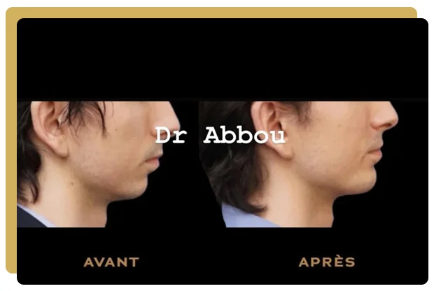 Augmentation menton par protheses