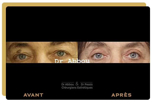 Blepharoplastie paris