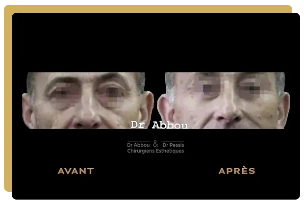 Lifting centro-facial paris