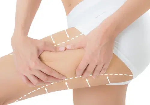 Lifting des cuisses
