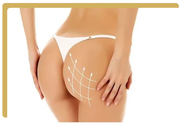 Lipofilling fesses brazilian butt lif paris