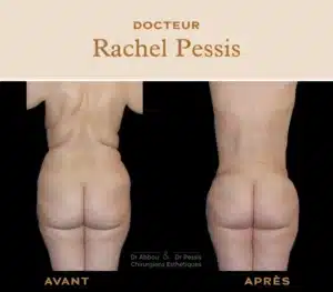 resultat lipoaspiration du dos